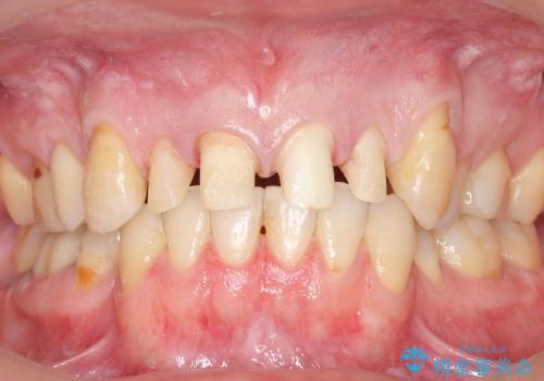 前歯のセラミック　放置した虫歯の全体的な治療の治療中