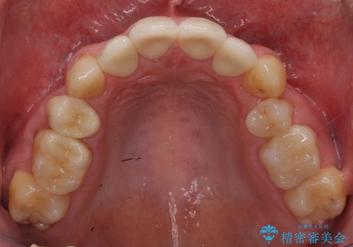 前歯のセラミック　放置した虫歯の全体的な治療の治療後