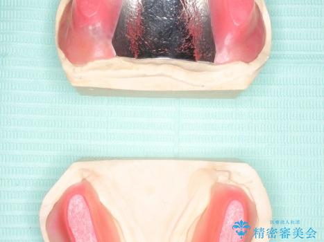 入れ歯が全く合わない　金属床を用いた総義歯の治療中