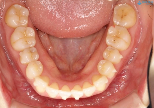 出っ歯、歯のねじれをインビザラインにて治療の治療中