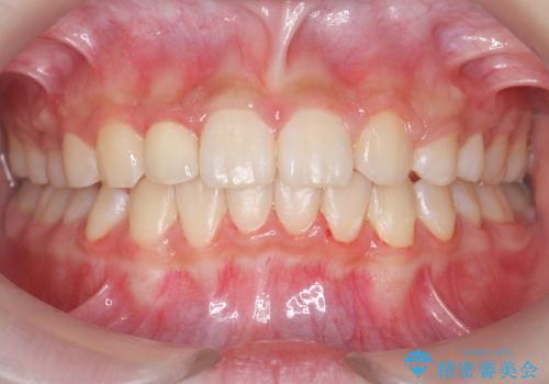 [10代女子]　すきっ歯　上の矮小歯・先天欠如　天然歯で隙間をつめる治療の治療後