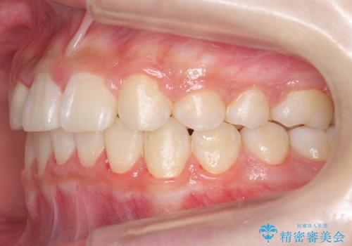 [10代女子]　すきっ歯　上の矮小歯・先天欠如　天然歯で隙間をつめる治療の治療後