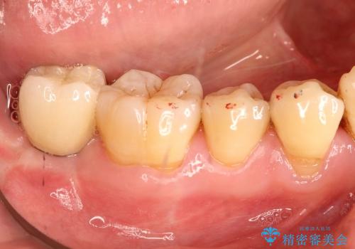 保存不可能な歯の抜歯後のインプラント治療の治療後
