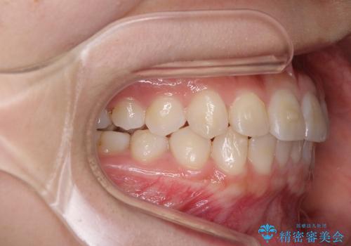 インビザラインで前歯のガタガタをきれいな歯並びへの治療中