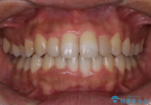 30代男性 フルリンガルによるガタつき八重歯の改善の治療中