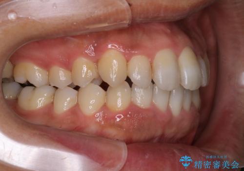 30代男性 フルリンガルによるガタつき八重歯の改善の治療中