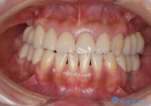 奥歯でかめない　インプラントによる咬み合わせの回復の治療後