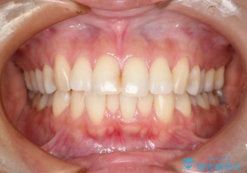 下の前歯の凸凹が気になるの症例 治療前