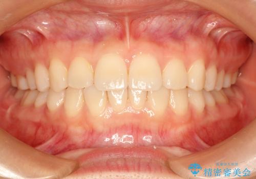 インビザラインで前歯のガタガタをきれいな歯並びへの症例 治療後