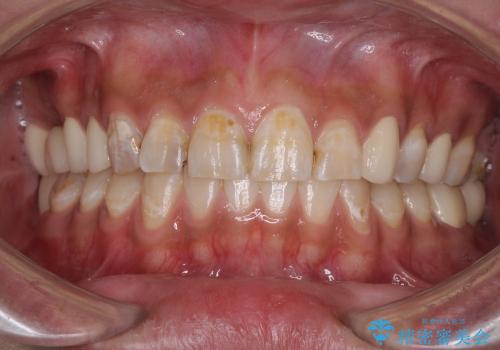 奥歯が虫歯だらけ　セラミックやインプラントによる虫歯治療の治療後