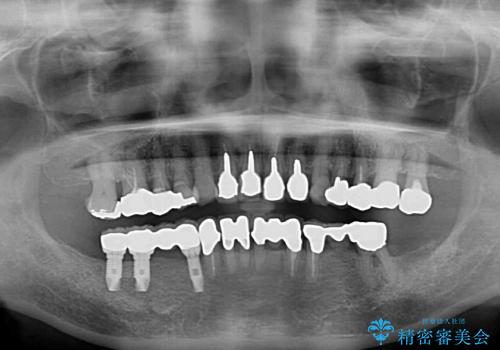 奥歯で咬めるようになりたい　インプラントによるかみ合わせの回復の治療後