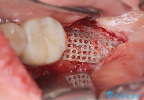 [ 大臼歯部骨造成・インプラント治療① ] 骨造成 ー インプラント埋入の治療後