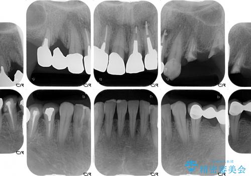 奥歯でかめない　インプラントによる咬み合わせの回復の治療前