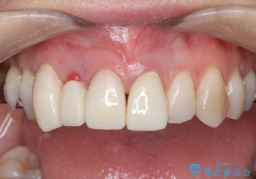 [セラミックを用いた前歯の歯並び治療 ②]  歯ぐきの成熟 ー 最終支台形成 ー セラミッククラウン・ブリッジの作製の治療前