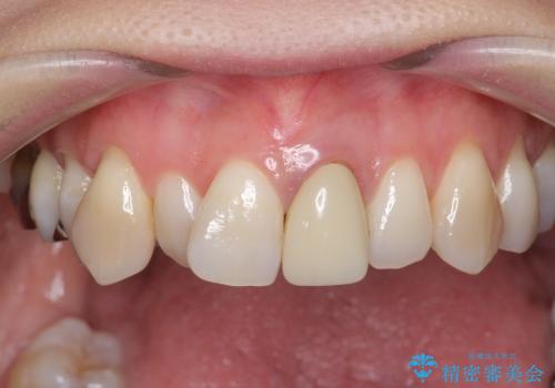 [セラミックを用いた前歯の歯並び治療 ①] 術前診断 ー 抜歯・仮歯の作製の治療前