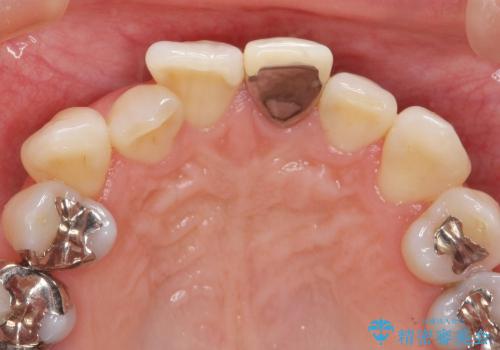 [セラミックを用いた前歯の歯並び治療 ①] 術前診断 ー 抜歯・仮歯の作製の治療前