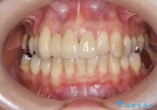 [セラミックを用いた前歯の歯並び治療 ②]  歯ぐきの成熟 ー 最終支台形成 ー セラミッククラウン・ブリッジの作製の治療後