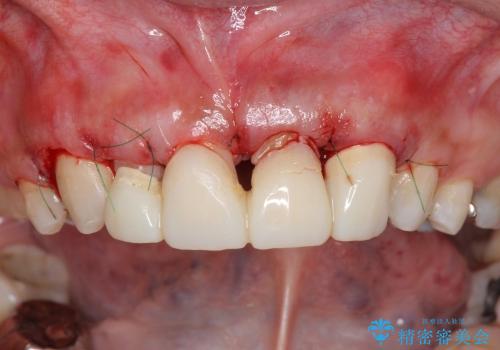 [歯ぐきの環境を整えてからの前歯の審美治療 ①] クラウンの除去 - 仮歯の作製 - 歯周外科手術の治療後
