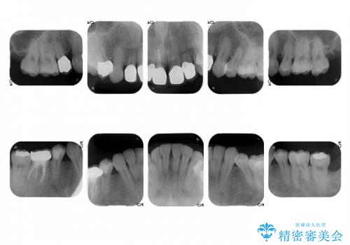 前歯のセラミック　放置した虫歯の全体的な治療の治療後