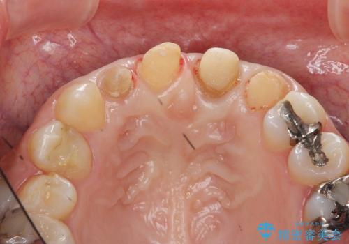 [歯ぐきの環境を整えてからの前歯の審美治療 ②]  歯周外科手術治癒後のセラミッククラウン作製の治療中