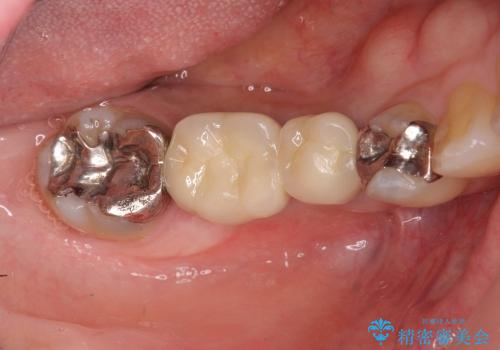 [乳歯の晩期残存]  残せない乳歯のインプラントによる咬合回復の治療後
