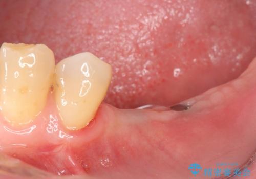 奥歯の喪失　インプラントによる咬合回復の治療中