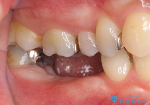 [乳歯の晩期残存]  残せない乳歯のインプラントによる咬合回復の治療中