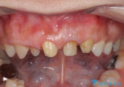 [歯ぐきの環境を整えてからの前歯の審美治療 ①] クラウンの除去 - 仮歯の作製 - 歯周外科手術の治療後