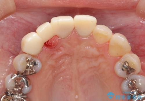 [セラミックを用いた前歯の歯並び治療 ①] 術前診断 ー 抜歯・仮歯の作製の治療後