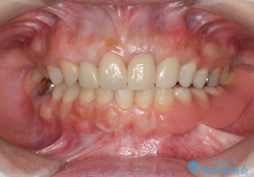 [歯ぐきの環境を整えてからの前歯の審美治療 ②]  歯周外科手術治癒後のセラミッククラウン作製の治療後