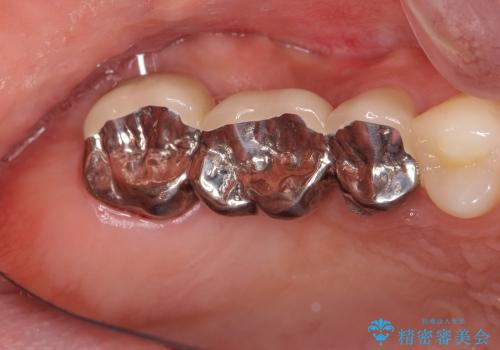 歯周外科手術を併用し清掃性を高めたブリッジ治療の治療前