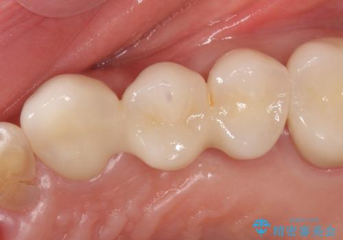 歯ぎしりで歯がグラグラ　噛み合わせを改善するブリッジ治療の治療後