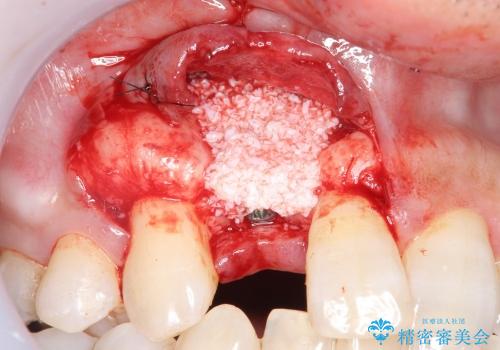 [ 骨造成を伴う前歯審美インプラント① ] インプラント埋入→2次手術の治療中
