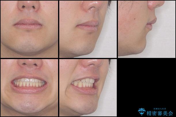 インビザラインによる非抜歯矯正　半年で前歯のがたがたを解消の治療後（顔貌）