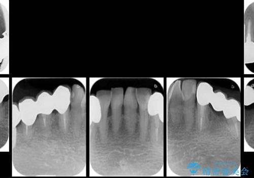 下顎の歯周病治療　コーヌスデンチャーを活用した入れ歯の再製作の治療後