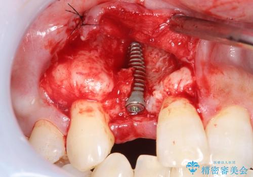 [ 骨造成を伴う前歯審美インプラント① ] インプラント埋入→2次手術