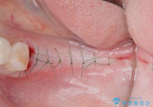 インプラントによる奥歯の咬合機能回復　クラウン高径のない場合骨外科による対応の治療前