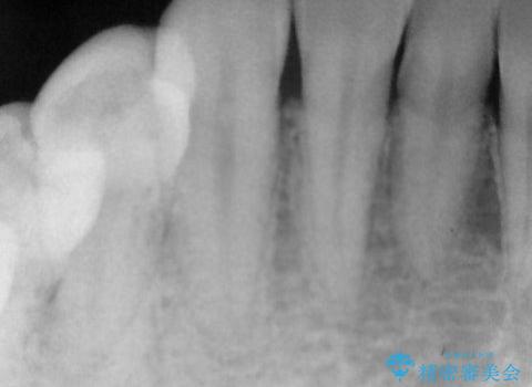 抜歯の提案を受けて、それが受け入れられずに転院されてきたケース:右下4番の歯の神経が壊死してしまったことによる根尖性歯周炎に対する精密根管治療(イニシャルトリートメント)ケースの治療前