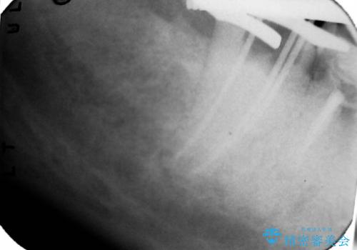 石灰化による根管の閉塞を伴う根尖性歯周炎 : 右下7番の再根管治療(リトリートメント)ケースの治療中