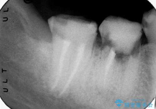 石灰化による根管の閉塞を伴う根尖性歯周炎 : 右下7番の再根管治療(リトリートメント)ケースの治療後