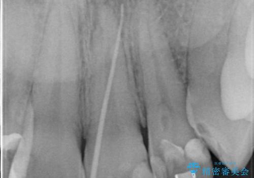 矯正治療中の根管治療(イニシャルトリートメント)ケース:歯髄壊死と根尖部からの排膿を起こしていた左上1番への精密根管治療の治療前