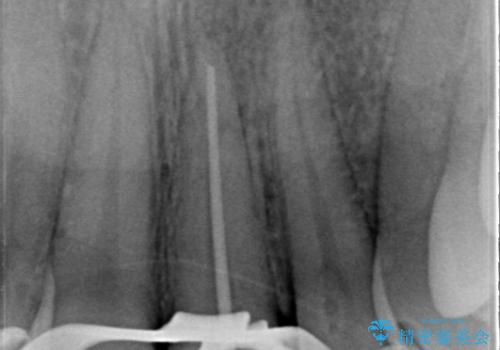 矯正治療中の根管治療(イニシャルトリートメント)ケース:歯髄壊死と根尖部からの排膿を起こしていた左上1番への精密根管治療の治療中