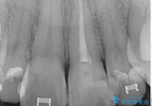 矯正治療中の根管治療(イニシャルトリートメント)ケース:歯髄壊死と根尖部からの排膿を起こしていた左上1番への精密根管治療の治療後