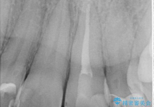 矯正治療中の根管治療(イニシャルトリートメント)ケース:歯髄壊死と根尖部からの排膿を起こしていた左上1番への精密根管治療の治療後