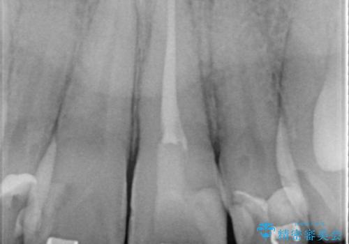 矯正治療中の根管治療(イニシャルトリートメント)ケース:歯髄壊死と根尖部からの排膿を起こしていた左上1番への精密根管治療