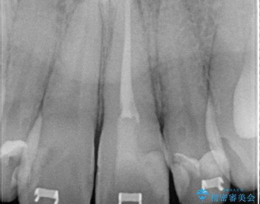 矯正治療中の根管治療(イニシャルトリートメント)ケース:歯髄壊死と根尖部からの排膿を起こしていた左上1番への精密根管治療