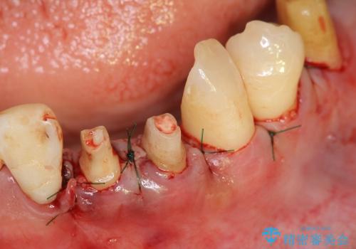 [ 前歯の歯周病治療① ]  再生治療・歯周ポケット除去の治療中
