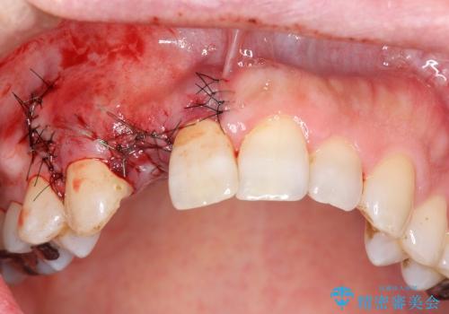 [ 骨造成を伴う前歯審美インプラント① ] インプラント埋入→2次手術の治療中
