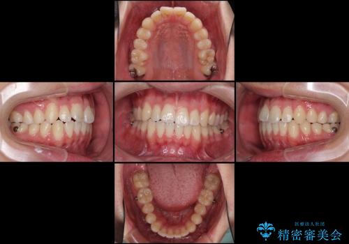 インビザラインによる非抜歯矯正　半年で前歯のがたがたを解消の治療中
