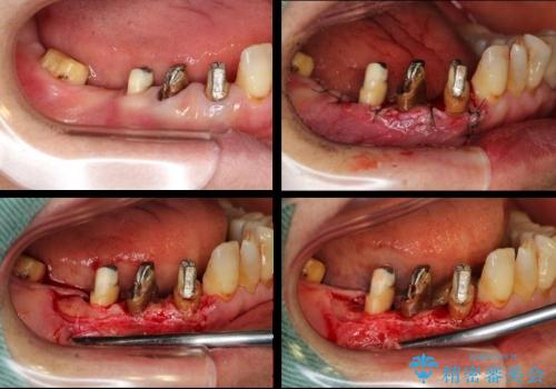 下顎の歯周病治療　コーヌスデンチャーを活用した入れ歯の再製作の治療中